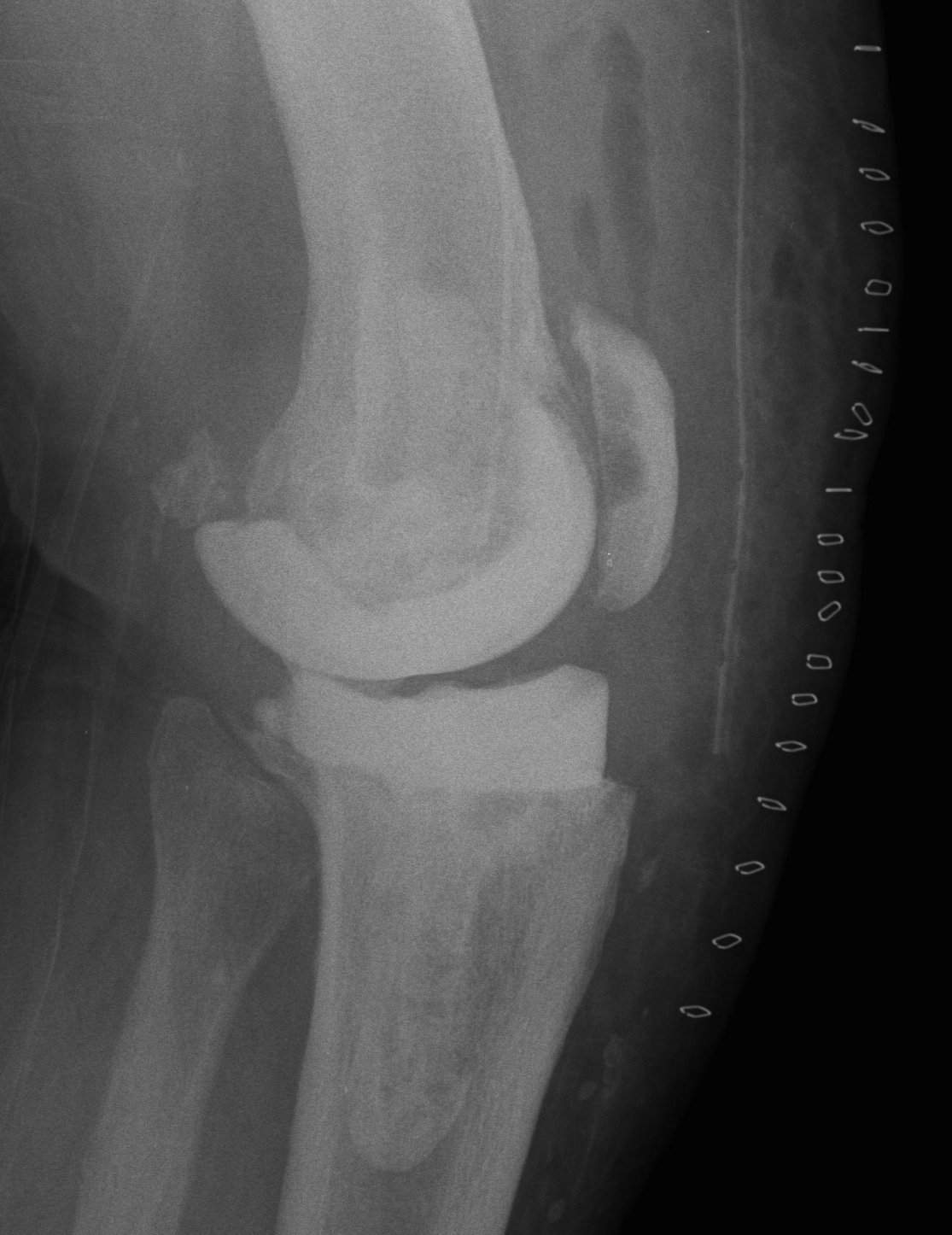 Infected TKR Cement Femur and Tibia